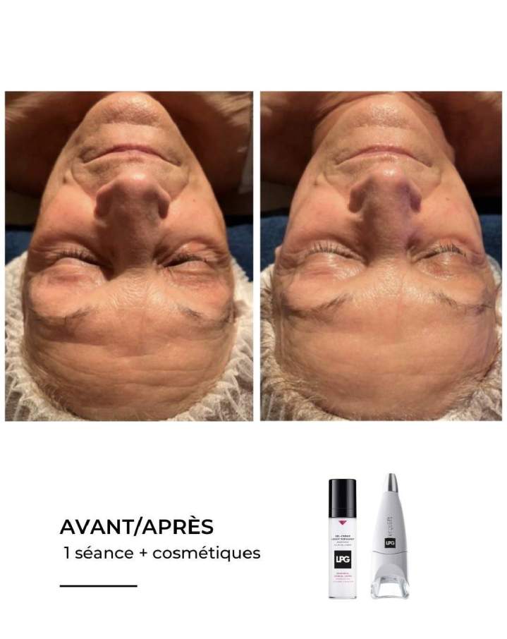 Endermologie 3