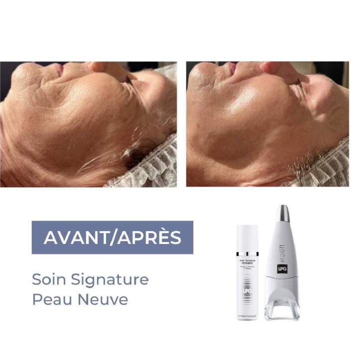 Endermologie visage 5