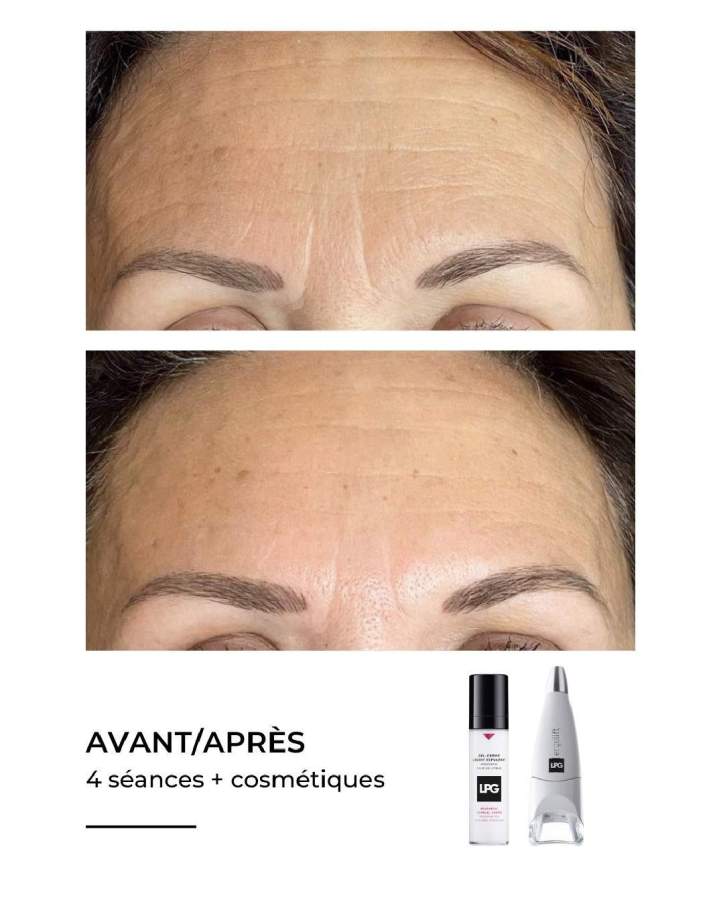 Endermologie visage