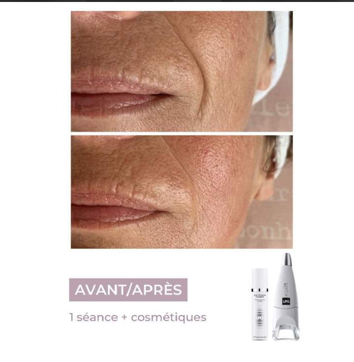 endermologie visage 2