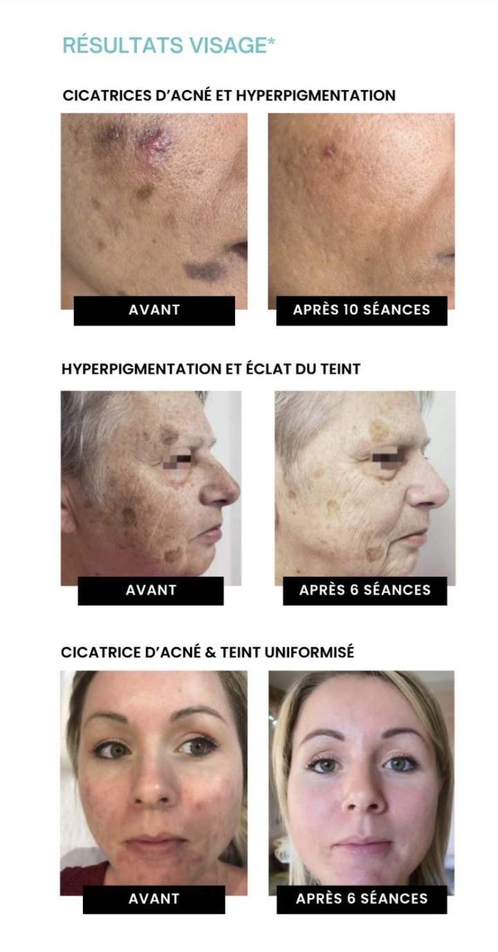 endermologie visage 4